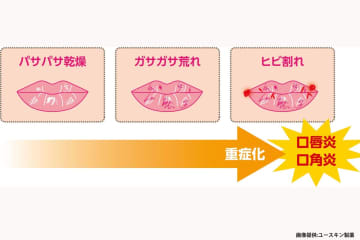 「ノーマスク解禁」で気になる唇荒れ　医師が推奨する“リップケア”が目からウロコ
