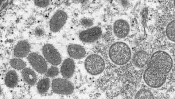 【速報】「サル痘」感染100人超える　今年に入り急増　厚労省