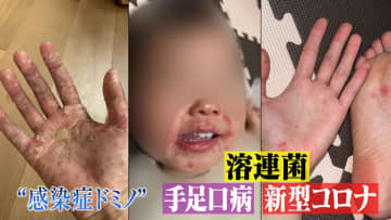 手足口病に溶連菌、新型コロナ…猛暑を襲う”警報級”感染症　家族が次々罹患する“感染症ドミノ”も発生　対策は？