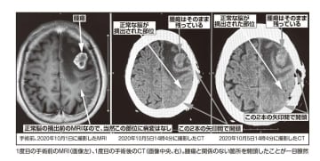 正常脳を切除、禁忌の処置で死亡!京都第一赤十字病院医療事故隠蔽事件 「12人死亡」の新事実|長谷川学 正常脳を切除、禁忌の処置で死亡――なぜ耳を疑う医療事故が相次いで起きているのか。その実態から浮かびあがってきた驚くべき杜撰さと隠蔽体質。ジャーナリストの長谷川学氏が執念の取材で事件の真相を暴く。いま「白い巨塔」で何が起きているのか。