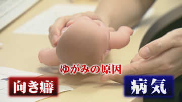 お子さんの頭の形気になりますか？「向き癖」かそれとも「病気」か…早期発見と治療が大切　専門外来が助言【島根発】