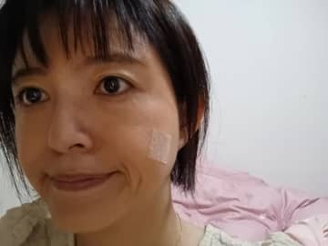 「1ヵ月程度テーピングが必要」 気象予報士、ほくろ除去手術後の経過を報告