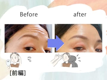 「おでこにシワがなくなるだけでこんなに違うの!?」43歳、5分で若見えするコスパ抜群な美容医療にハマった理由