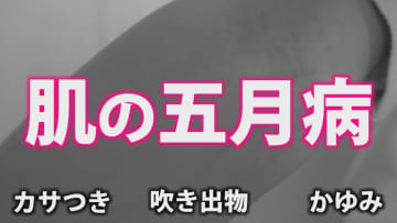 肌も五月病になる！？　新生活のストレスが引き起こす肌トラブル　適切なケアと“汗活”で夏への備えを