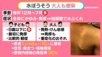 大人は重症化も……水ぼうそうが“異例の流行”ナゼ　感染力どれほど強い？　治っても「帯状疱疹」に注意【#みんなのギモン】