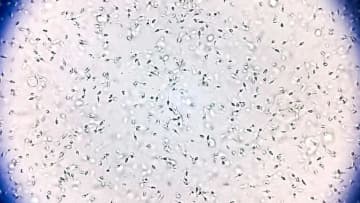 まれな変異遺伝子持つ精子ドナーから６７人の子ども、１０人ががんに　規制求める声