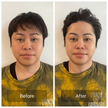ノンスタ井上、美容施術ビフォーアフターショットに反響