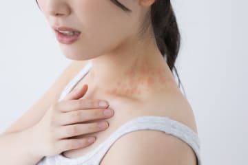 水ぼうそうの患者数が急増…いったいなぜ？大人になって初感染すると脳炎のリスクも