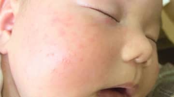 顔や頭皮がカサカサに…乳児や40代、50代に多い脂漏性皮膚炎　皮脂の分泌増える初夏は要注意
