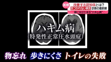 「認知症だと思っていた」物忘れ、歩行困難…「ハキム病」診断の最前線…手術で症状改善へ『every.特集』