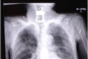 高齢男性の喉から“鍵”、死因はコロナ？ 遺族が病院提訴「真実を知りたい」