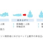 パーキンソン病患者ベッド上動作の自立度低下の関連要因　畿央大学が解析