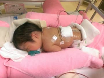 妊娠19週の健診で「おしりに空洞がある」と言われ、帝王切開で生まれた娘の背中には600gのこぶが･･･。「ごめんね」と涙がとまらない【二分脊椎・体験談】
