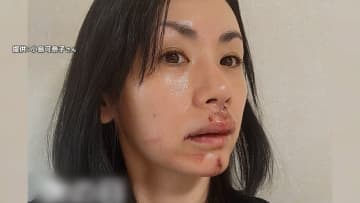タレント・小島可奈子さんの顔を犬が“ガブリ”「傷跡が残ります」医師が断言…30針も縫う大けが