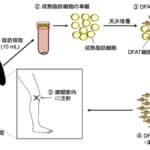 世界初　患者の脂肪細胞由来「DFAT細胞」を使った変形性膝関節症の臨床研究を開始　日本大学