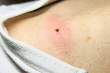 愛知で2人死亡…マダニが媒介する感染症「SFTS」ペットや草むらの作業で感染「生息域は全国に」専門家が警鐘