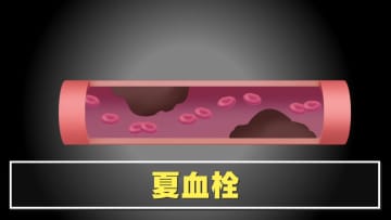 【危険】熱中症と間違えやすい「夏血栓」落とし穴と“魔の時間帯” 患者が語る怖さ「孤独死していたかも」
