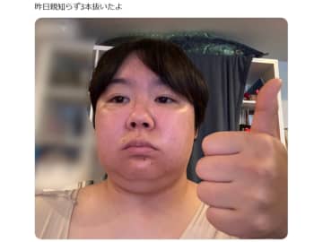 「あの人に激似…？？」やす子の親知らず抜歯ショットがそっくりでネットざわつく