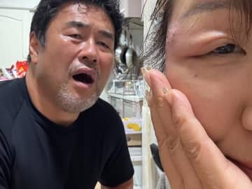 「帯状疱疹こんなに痛いとは」北斗晶、腫れた目元にファン騒然…佐々木健介も絶句
