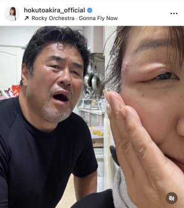 北斗晶、まぶたが腫れて「お岩さんみたい」「仕事がやばい」…診断結果を公表「こんなに痛いとは たまげたーーーー」