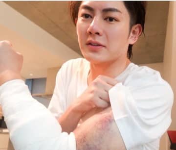 三崎優太「必ず乗り越えます」バイク事故の後遺症で再手術。「無理せず、頑張って下さい！！」と応援殺到