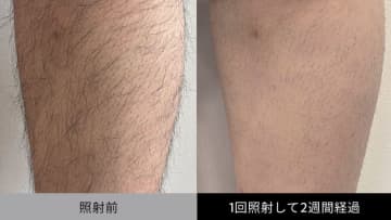 【男のムダ毛】剛毛でも痛くない高速処理！ マンダムの光美容器『ium スピードショット』レビュー