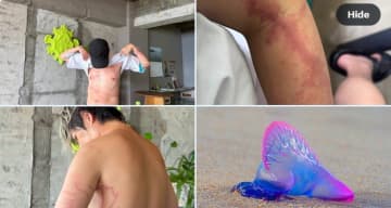 ウーマン村本、お盆過ぎの海で電気クラゲに刺され救急搬送。痛々しい被害写真と「美しい化け物」の正体とは