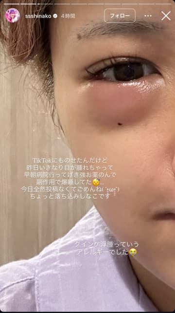 しなこ、突然のアレルギーで病院へ。インスタで公開した『痛々しい顔』にファンから心配と激励の声