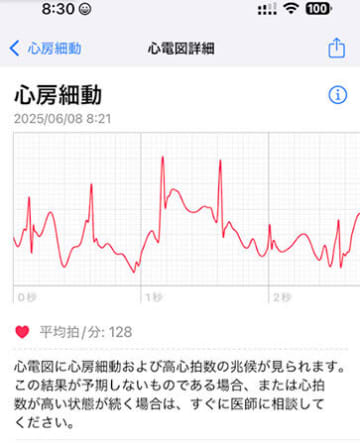 Apple WatchのCMの「心房細動」が見つかって手術！入院中を快適に過ごすには？