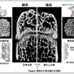 骨の減少に喘息が関与することを佐賀大学などが発見　アレルギー患者の骨維持に新知見