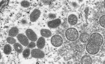 重症型ウイルス初上陸…「第二の天然痘」エムポックスが日本で騒がれない理由