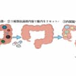 潰瘍性大腸炎の患者にドナーの腸内細菌を移植する療法　寛解導入率46％を達成