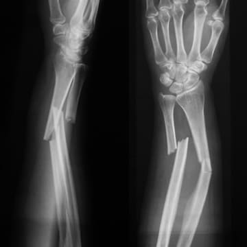 骨折部に注射してたった3分で固定可能！ 中国で革命的な接着剤が開発され大注目