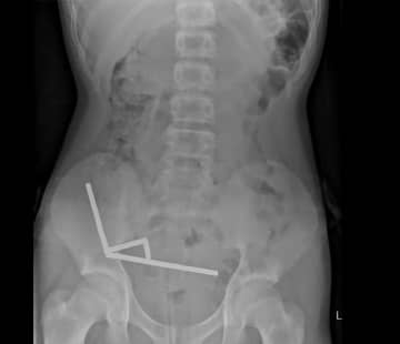 超強力磁石を大量にのみ込んだ１３歳少年、腸の壊死で一部を摘出　ＮＺ