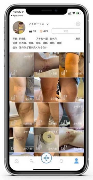 アトピー解析ＡＩモデル登場　患者さん自身が撮影した画像から重症度を判定