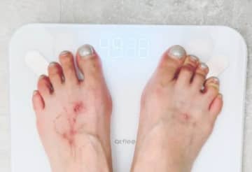 数多くのタトゥーを入れていたヒョナ、除去中の近況を公開　“妊娠説”を吹き飛ばすダイエットの成果も【PHOTO】