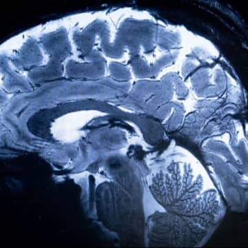 毎日のわずかな散歩、アルツハイマー型認知症を遅らせる効果あり
