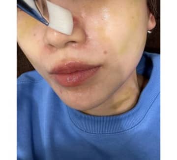 あいのり・桃、医師も驚く“ニキビ治療”を報告