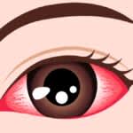 アトピー角結膜炎を改善する物質を発見　世界初の慢性アレルギー性結膜炎の分子標的薬に期待