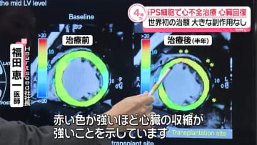 iPS細胞で心不全治療 心臓の機能が回復 大きな副作用なし…世界初の治験