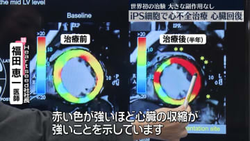 iPS細胞で心不全治療　心臓の機能が回復　大きな副作用なし…世界初の治験