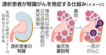 透析特有の腎臓がん解明　炎症で異常増殖、治療期待