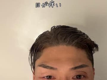 金爆・樽美酒研二、44歳最終日に謎のじんましんの検査結果を報告「トレーニングのやり過ぎ‥」