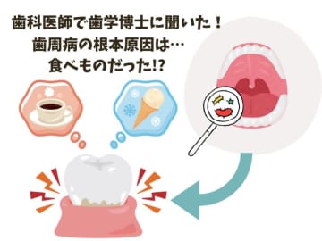 目からウロコ！ 歯科医師で歯学博士に聞いた、歯周病の根本的な原因は食事だった!?