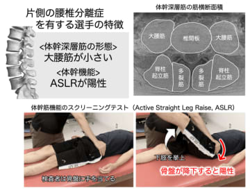 MRIと簡便な体幹筋機能のスクリーニングで“腰椎分離症”の特徴を解明
