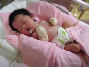 難産の末に生まれた直後、重症のてんかんを起こした長女。生後1カ月で「一生歩くこともしゃべることもできない」と【大田原症候群】