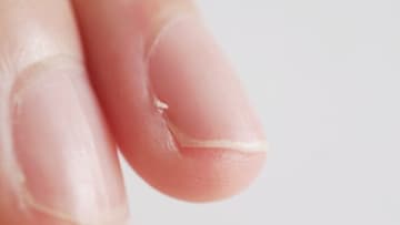 “ささくれ”悪化、炎症や「赤い線」が現れたら要注意、リンパ管炎になることも