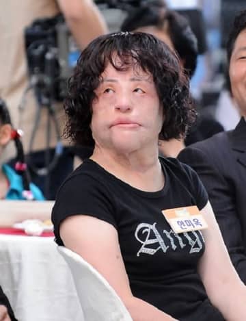 整形手術の副作用で苦しんだ「扇風機おばさん」、7周忌　死因は未だに不明のまま