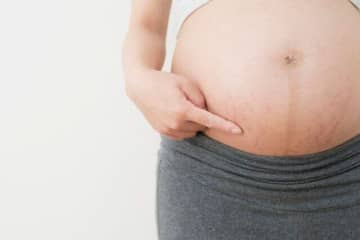 【産科医に聞く！】“妊娠線”ってなぜできるの？　できたらどうなる？