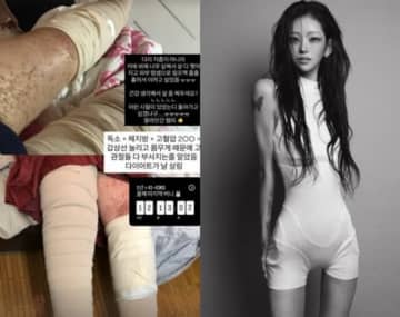 皮膚が裂けリンパ液がだらだら…元巨人投手の父と女優母を亡くした韓国インフルエンサー、闘病写真公開